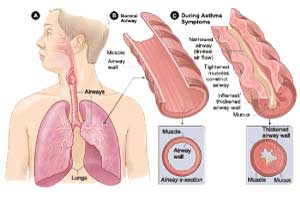 Attacco d'asma